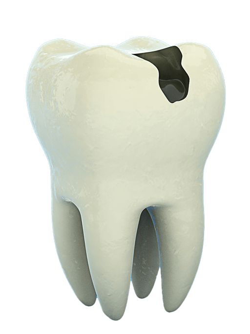 abgestorbene wurzelbehandelte Zähne